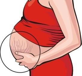 کرم ضد ترک دوران بارداری موستلا